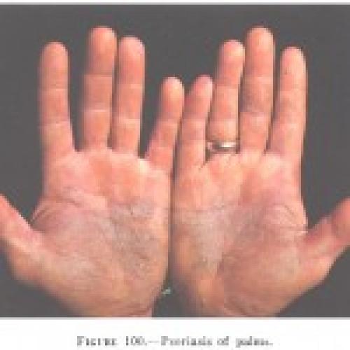 Psoriasis_of_the_palms